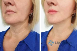 Double chin before and after Hi-Fu treatment 4 Book your double chin treatment Braunstone Frith today! We are here to help!
