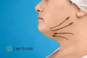 Double chin before and after Hi-Fu treatment 3 Boost your confidence with a Double chin treatment Braunstone Frith