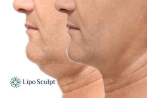 Double chin before and after Hi-Fu treatment 2 Double chin treatment Braunstone Frith from Lipo Sculpt - feel more confident today!