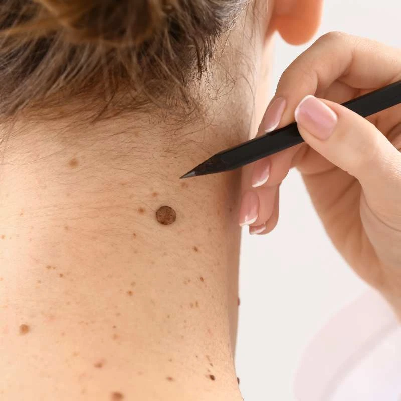 How to Support Your Body During Pregnancy for Faster Postnatal Recovery 5 See our lesion removal prices Braunstone Frith - call today for a free quote