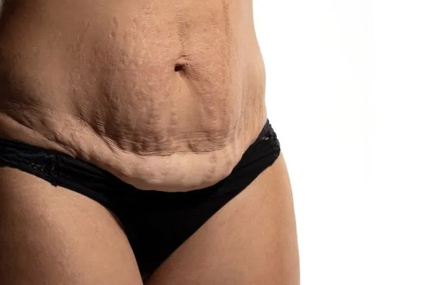 Lost the Weight but Not the Loose Skin? 1 image of womans stomach after weight loss showing loose skin Braunstone Frith